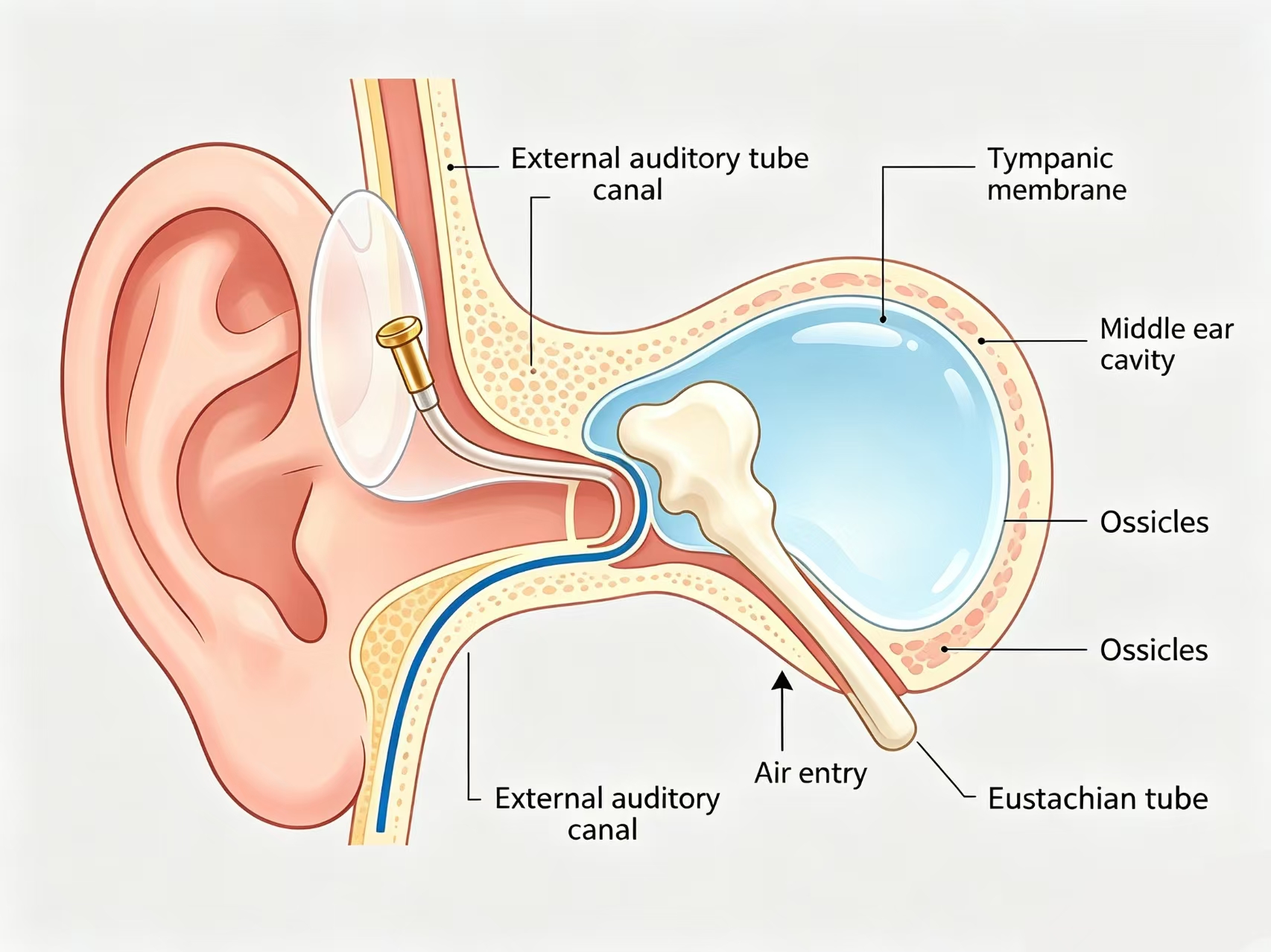 ear-tubes-tympanostomy-3d-illustration.jpg ear-tubes-tympanostomy-3d-illustration.jpg