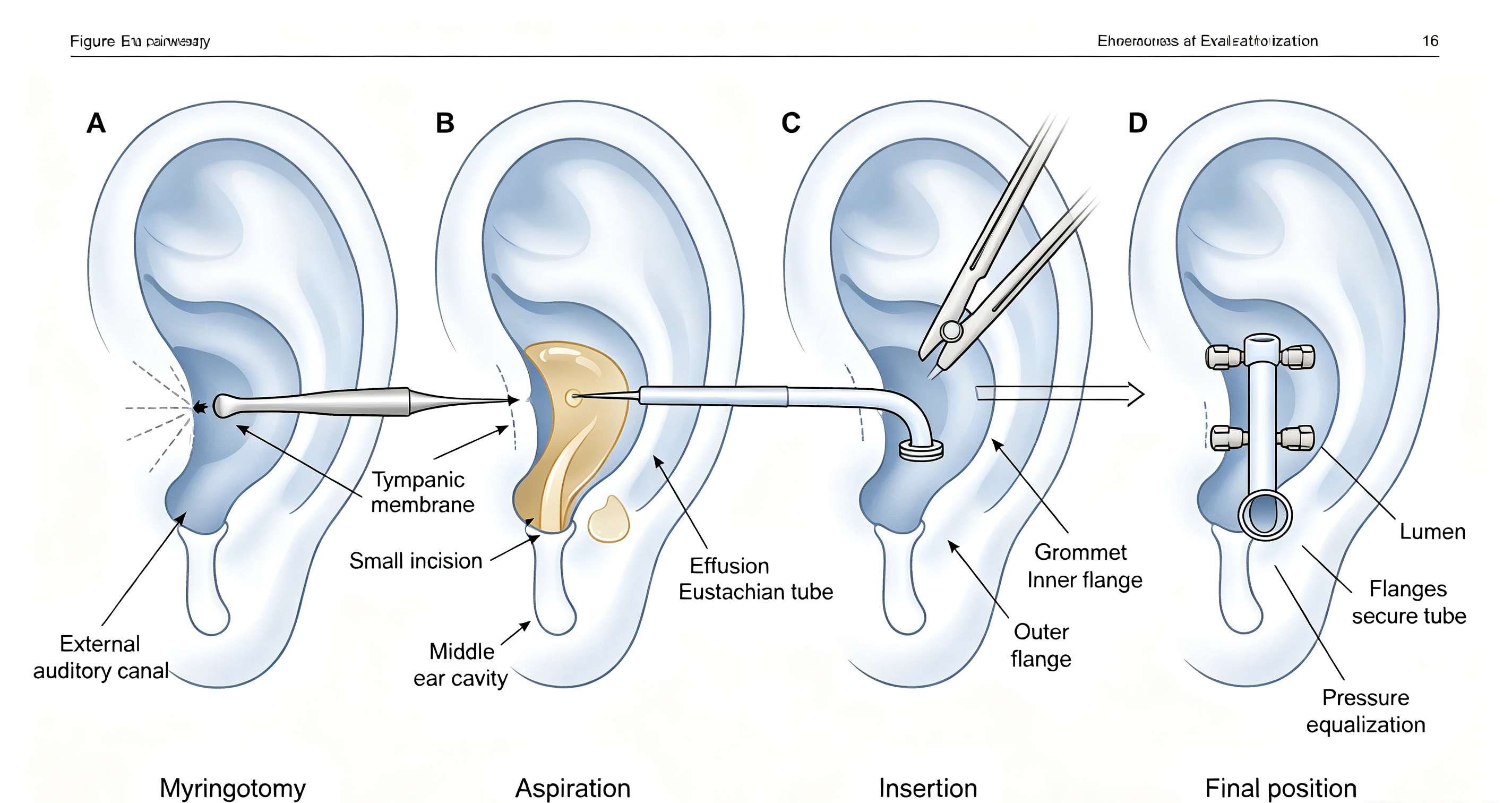 grommet-tympanostomy-tube-overview.jpg grommet-tympanostomy-tube-overview.jpg