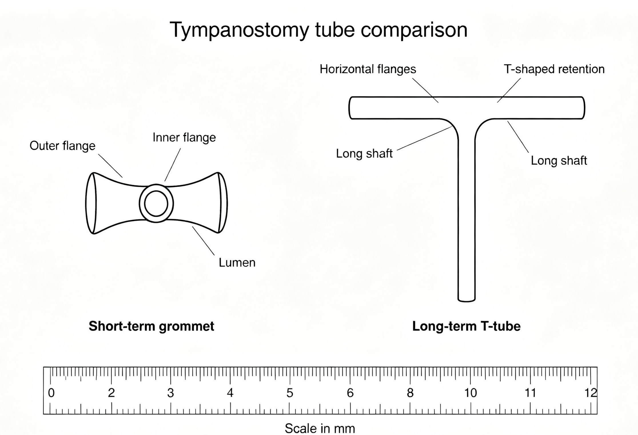 grommet-tympanostomy-tube-overview.jpg grommet-tympanostomy-tube-overview.jpg