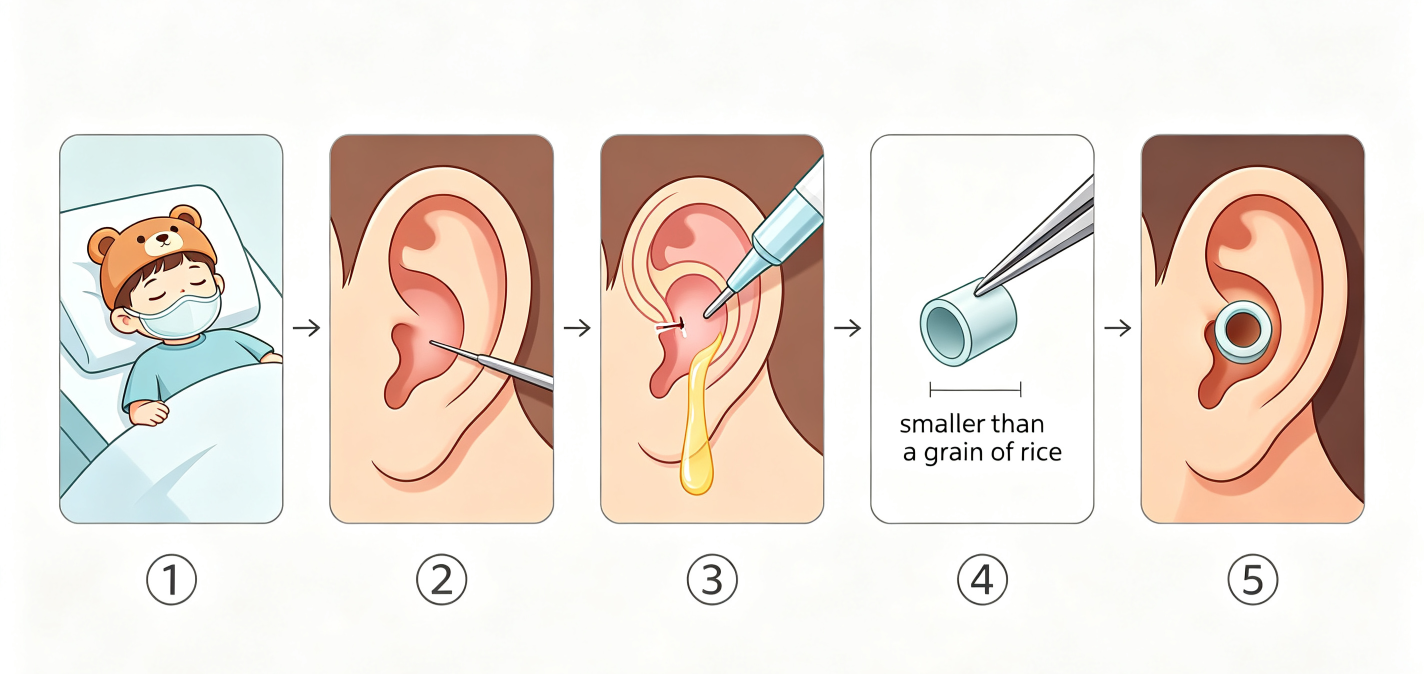 ear-tubes-for-kids-guide.jpg ear-tubes-for-kids-guide.jpg