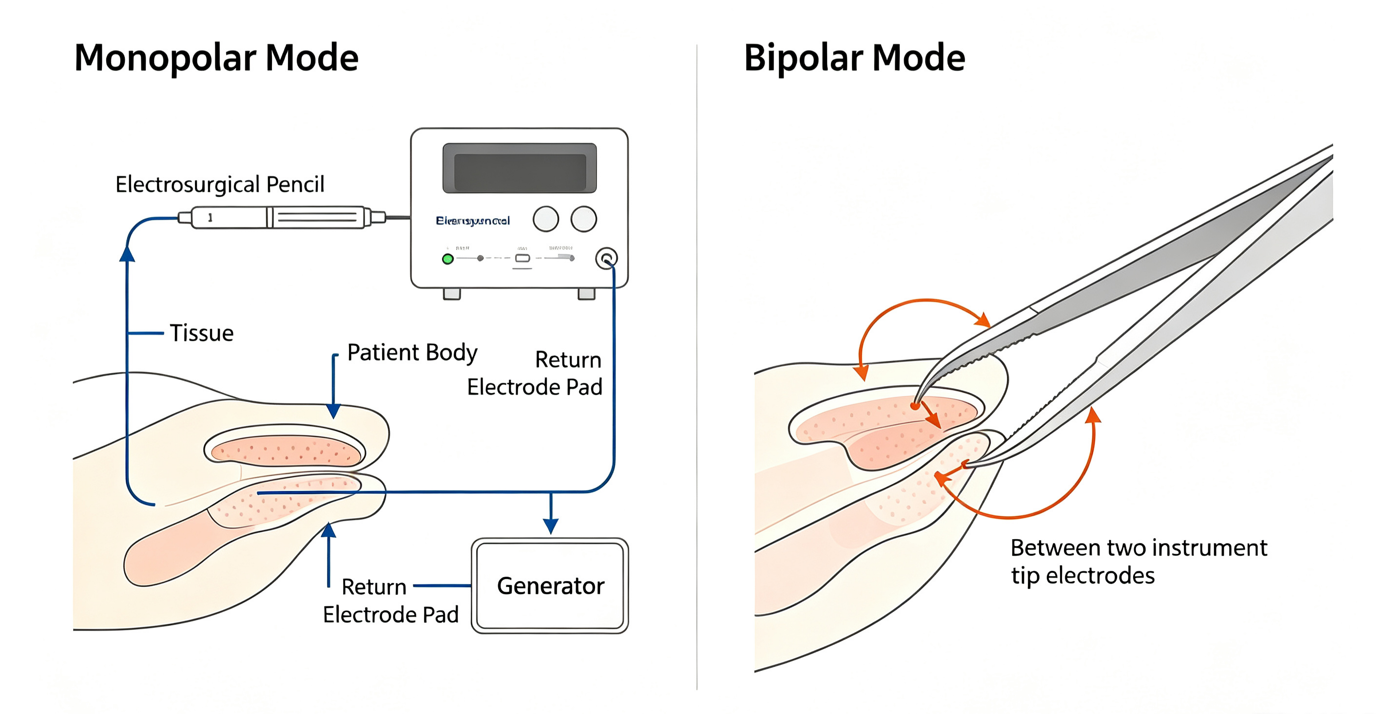 surgeon-using-electrosurgical-pencil-with-smoke-evacuation.jpg surgeon-using-electrosurgical-pencil-with-smoke-evacuation.jpg