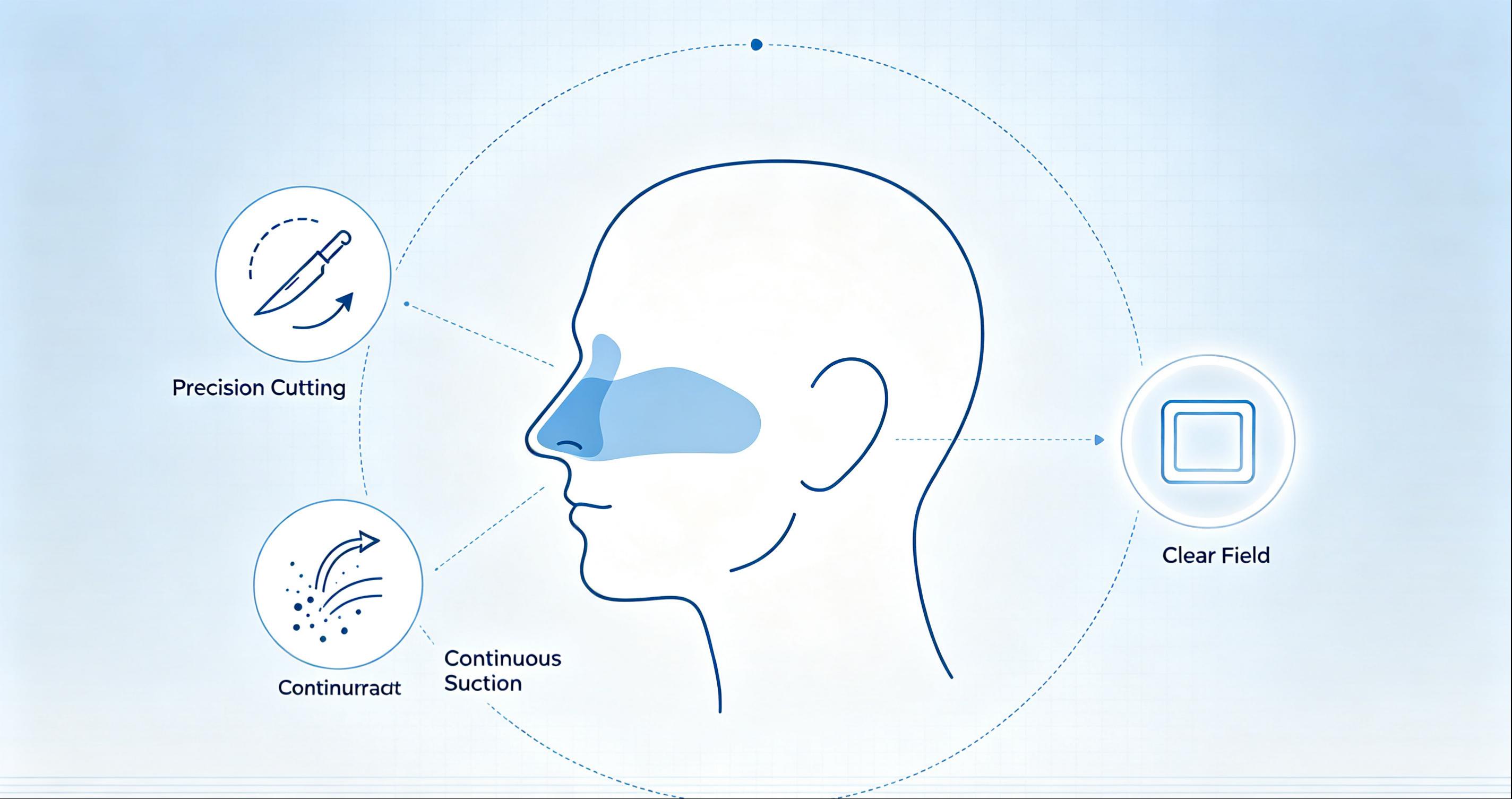 Microdebrider Applications in Endoscopic Sinus Surgery