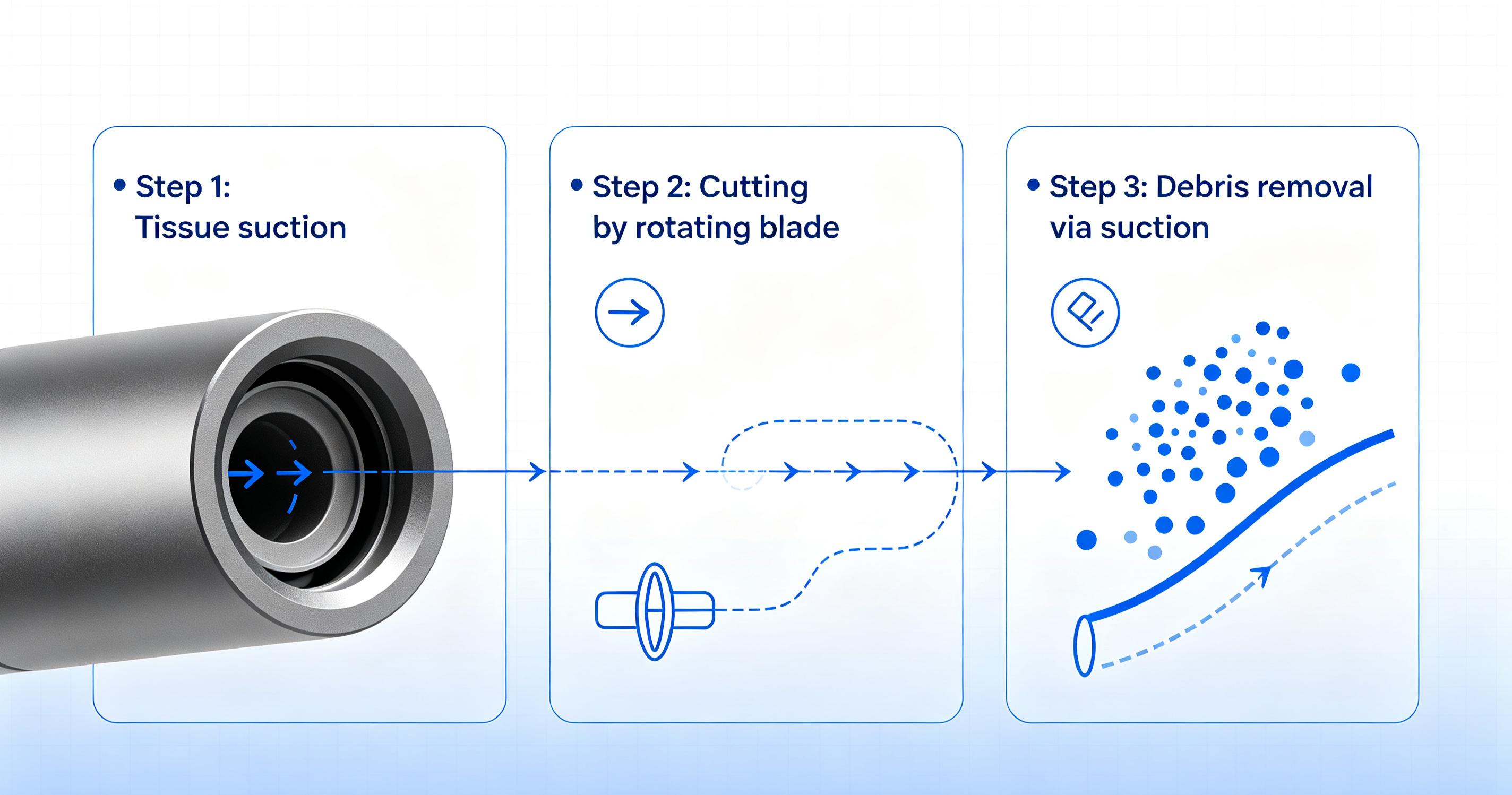 microdebrider-applications-endoscopic-sinus-surgery-overview microdebrider-applications-endoscopic-sinus-surgery-overview